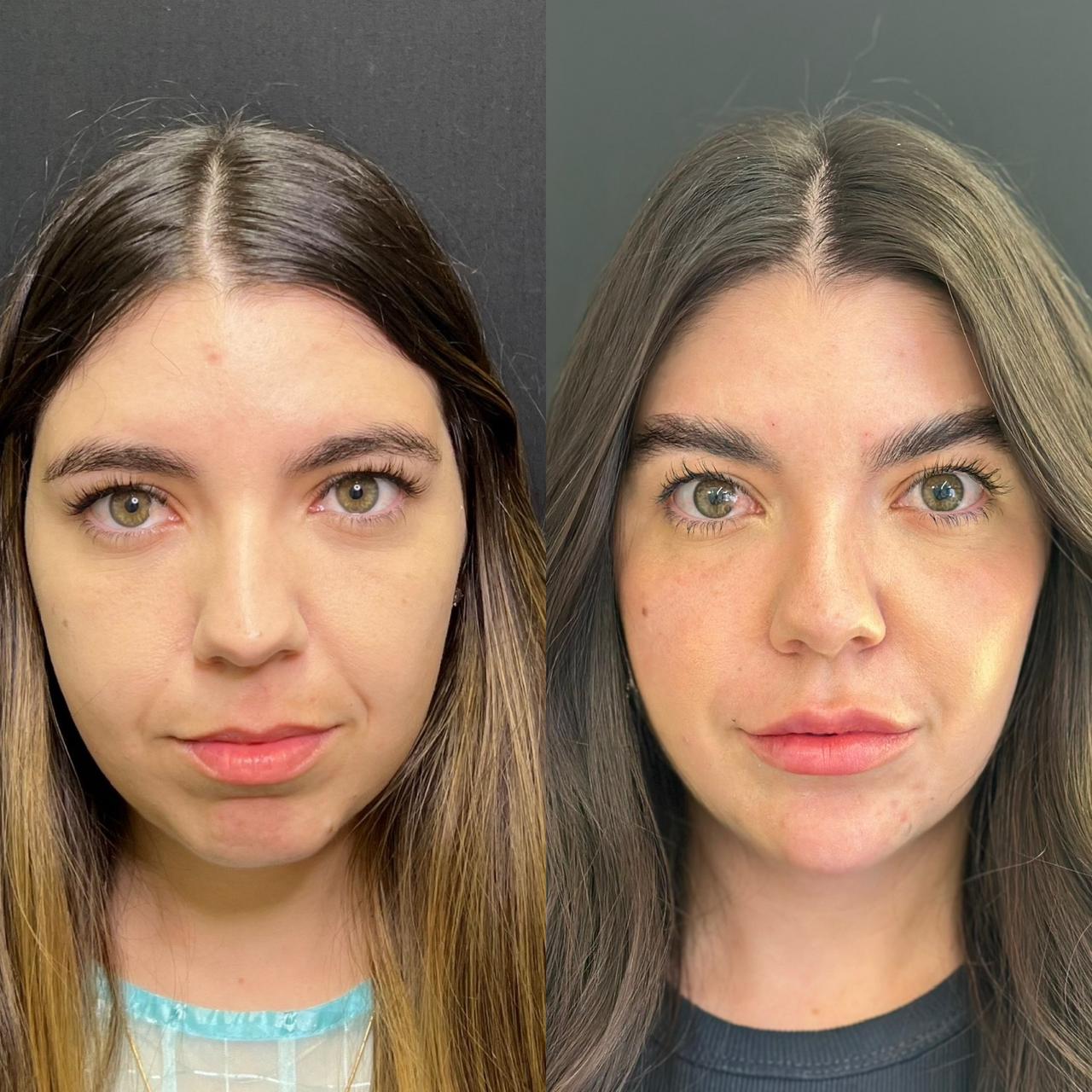 Comparação antes e depois, definição natural dos lábios