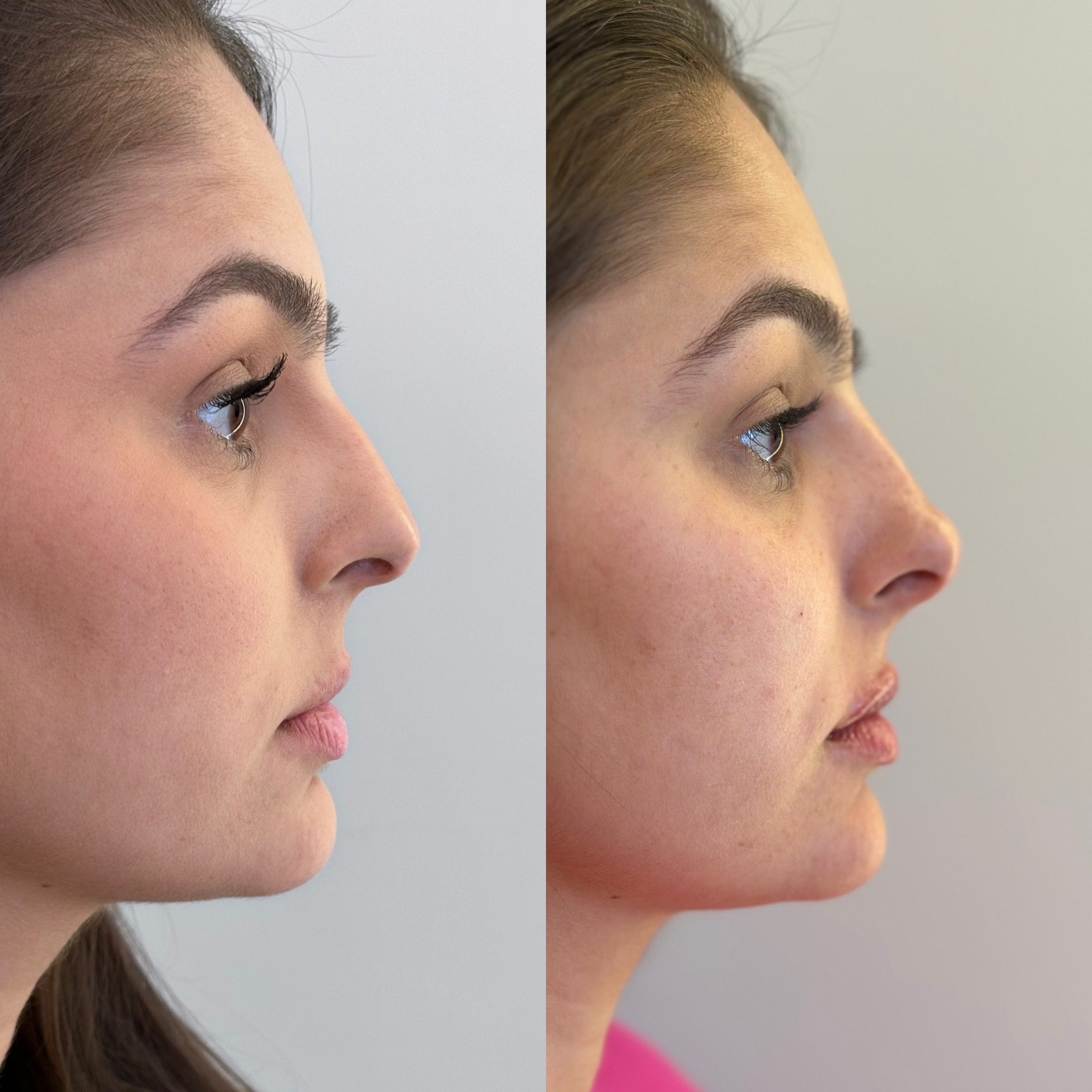 Comparação antes e depois, perfil e definição do queixo
