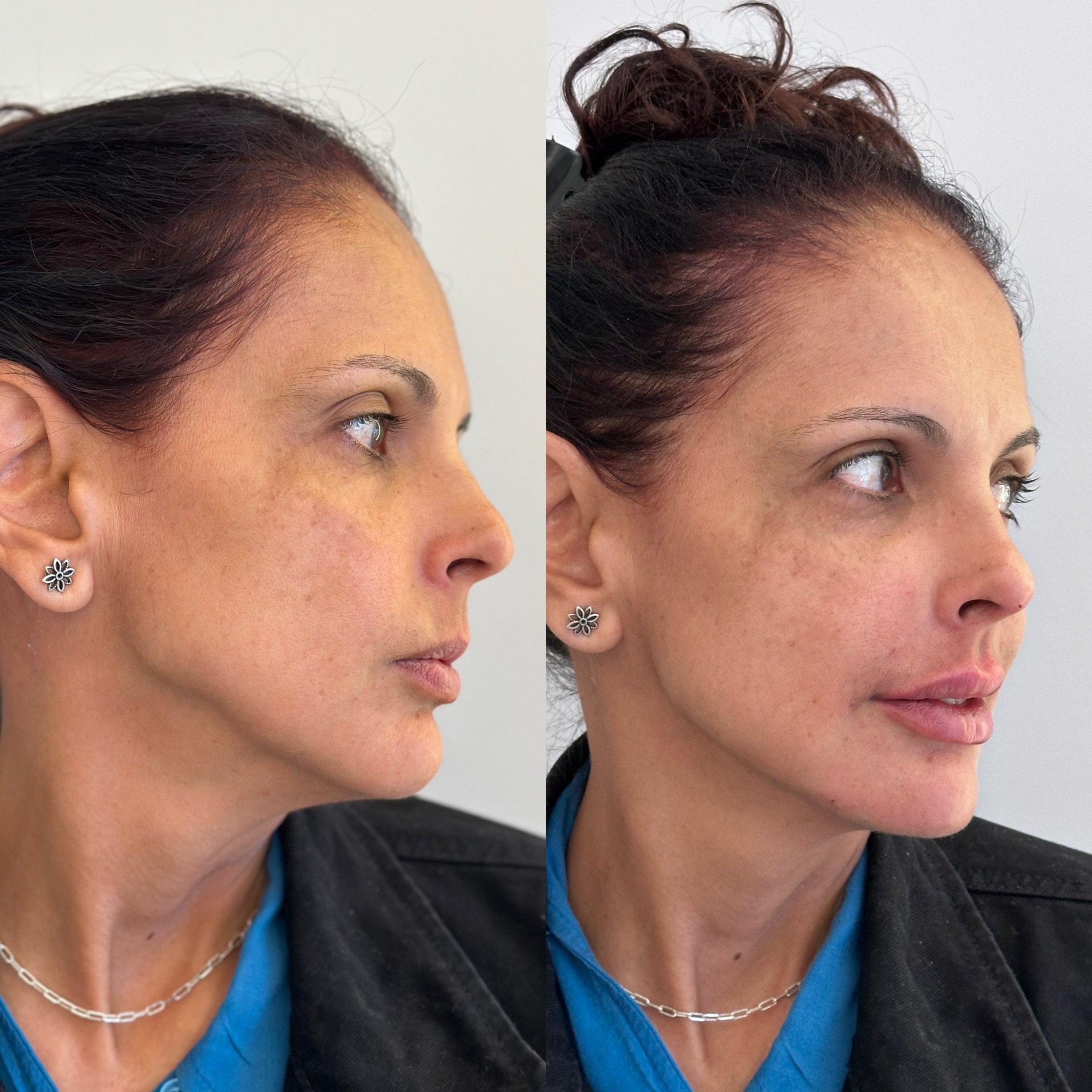 Comparação antes e depois, sustentação e aparência mais descansada
