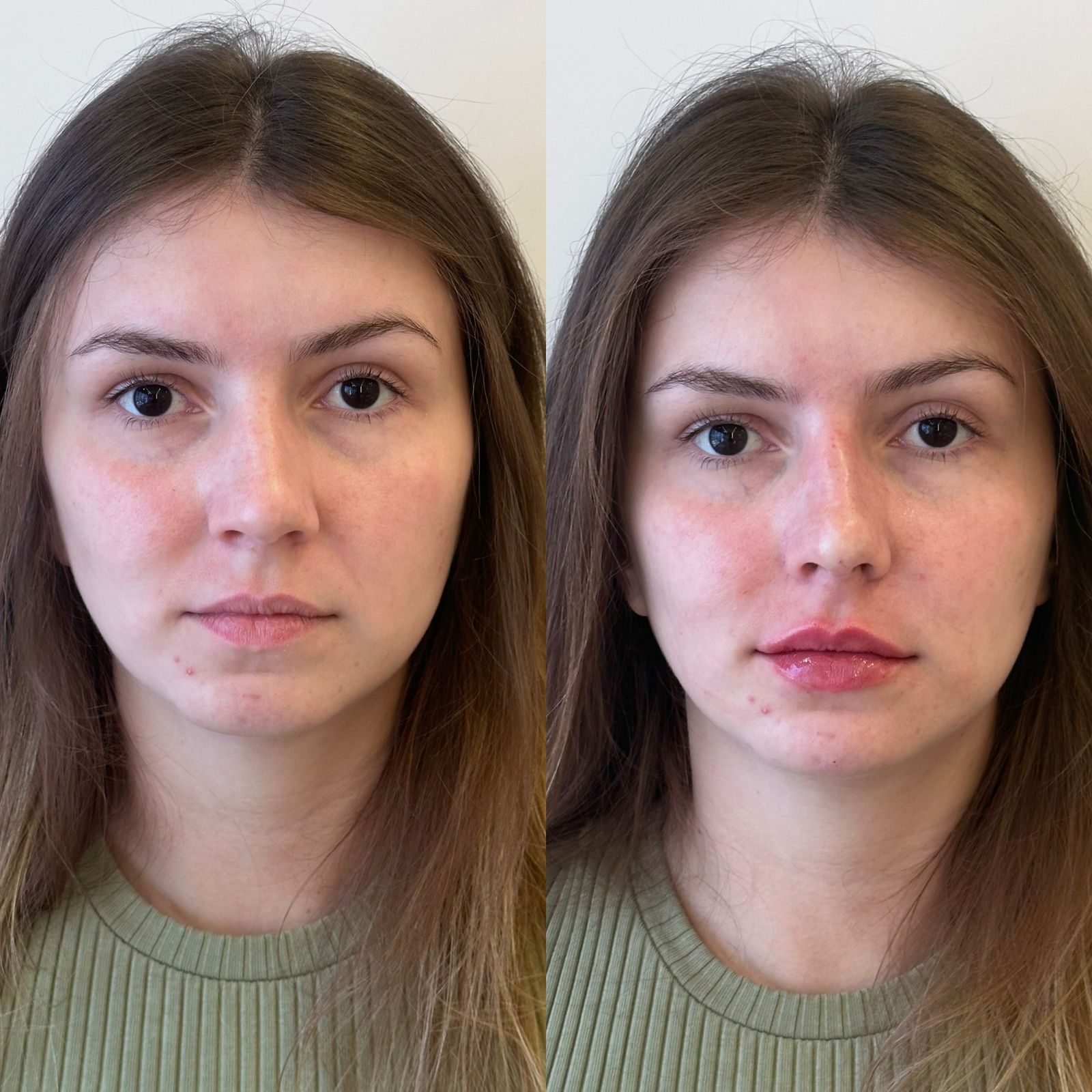 Comparação antes e depois, contorno e proporção labial