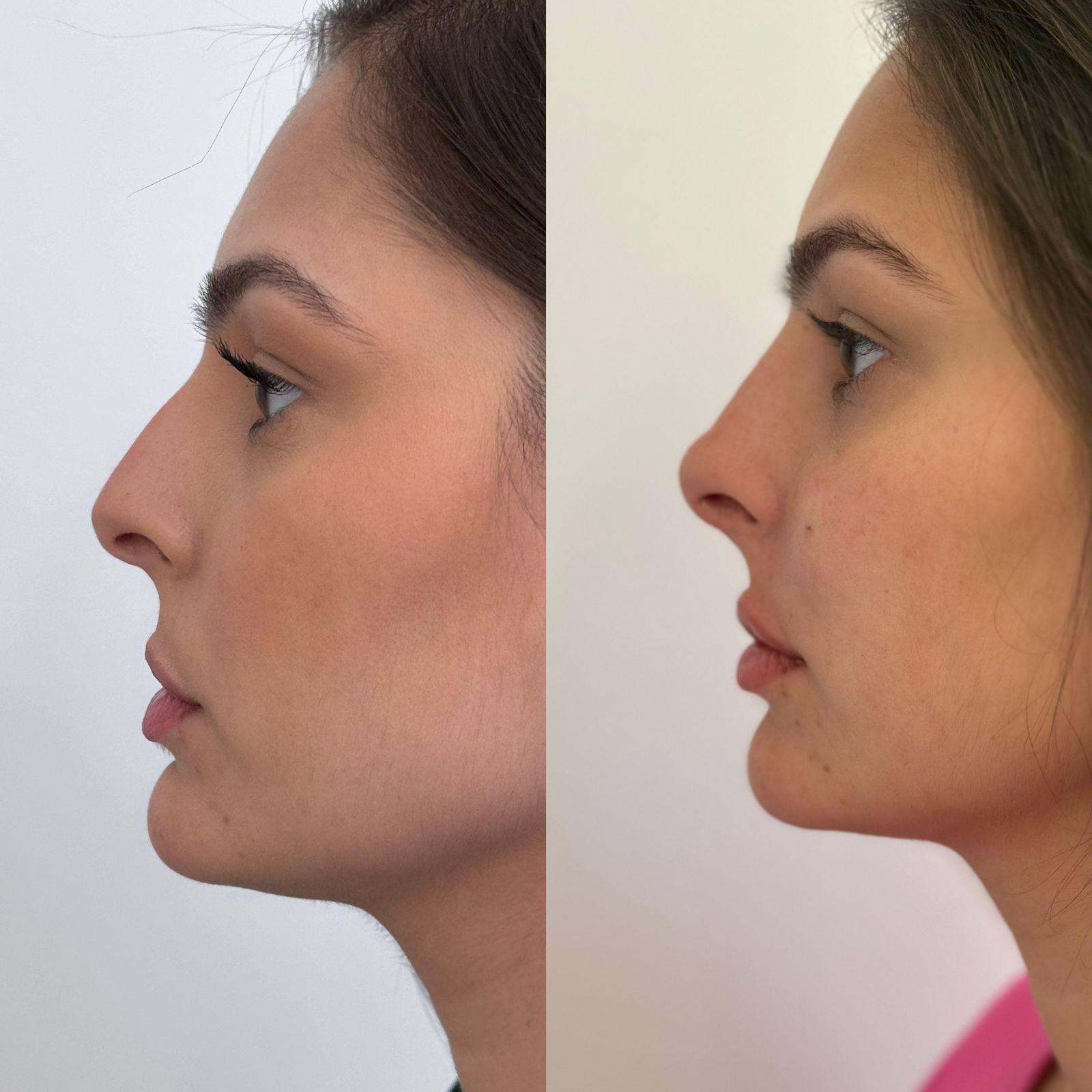 Comparação antes e depois, perfil e proporção nasal