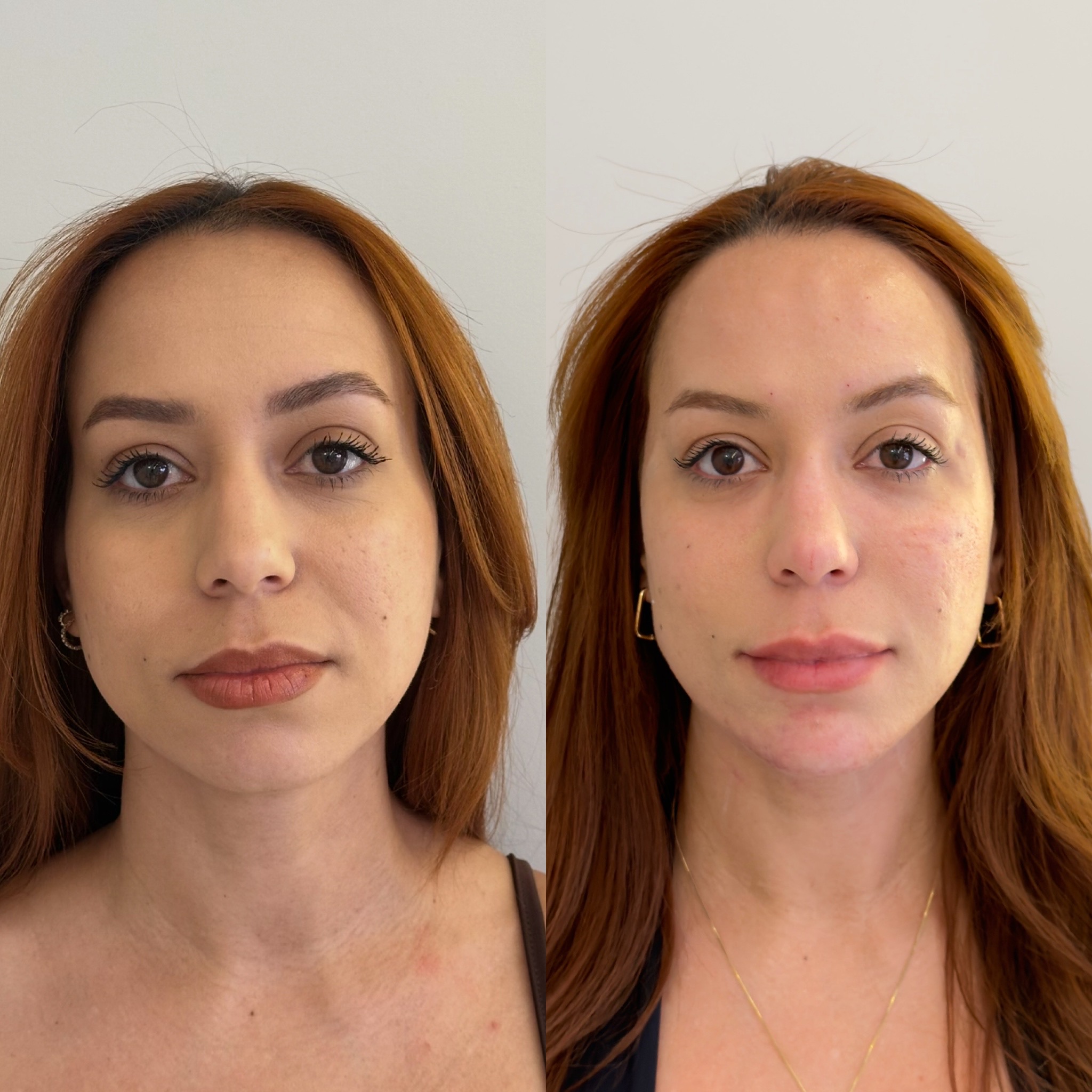 Comparação antes e depois, proporção e equilíbrio do rosto