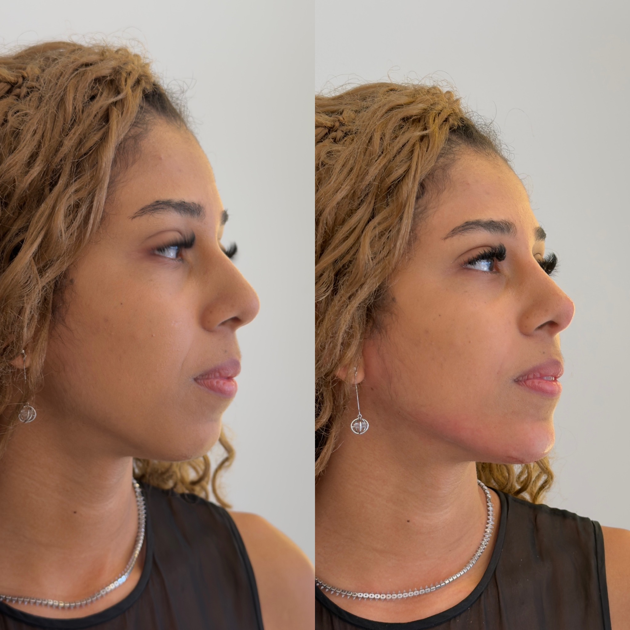 Comparação antes e depois, perfil e contorno da mandíbula